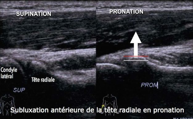 coude-echographie-osteopathie-4