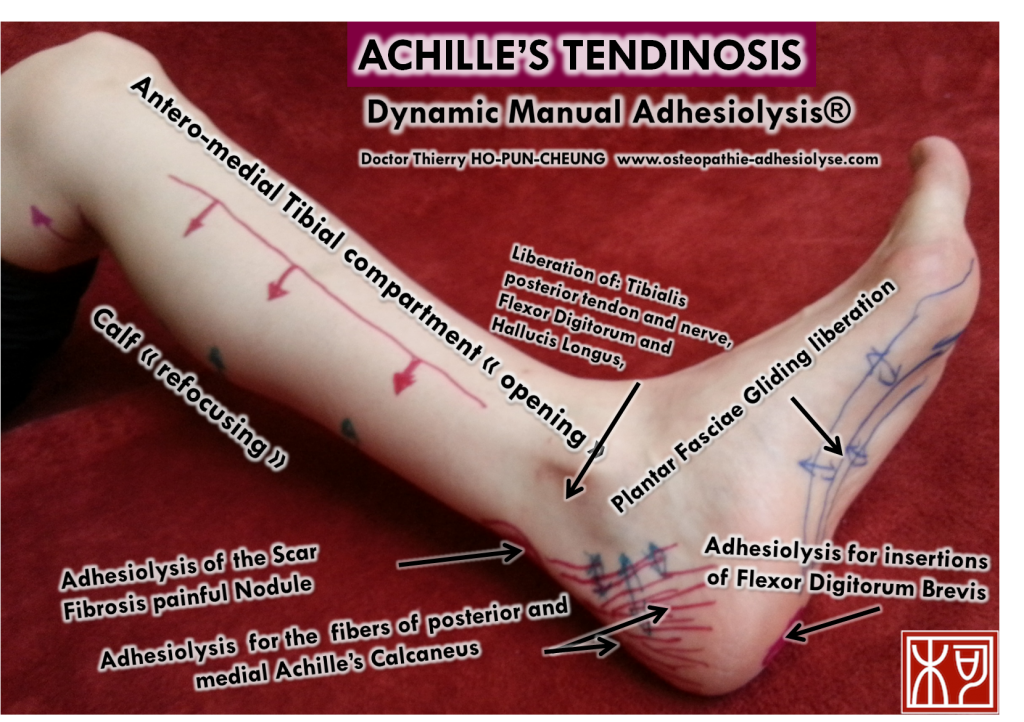 Achille's tendinosis manual treatment