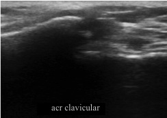 acromioclavicular-instability-ultrasonography-w10