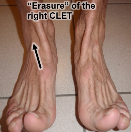 ankle-sprain-osteopathy