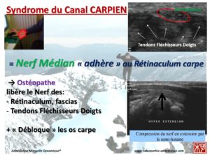 burn out et syndrome canal carpien