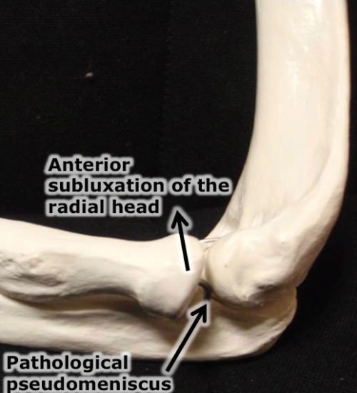 Effective manual treatment of Lateral Epicondylitis