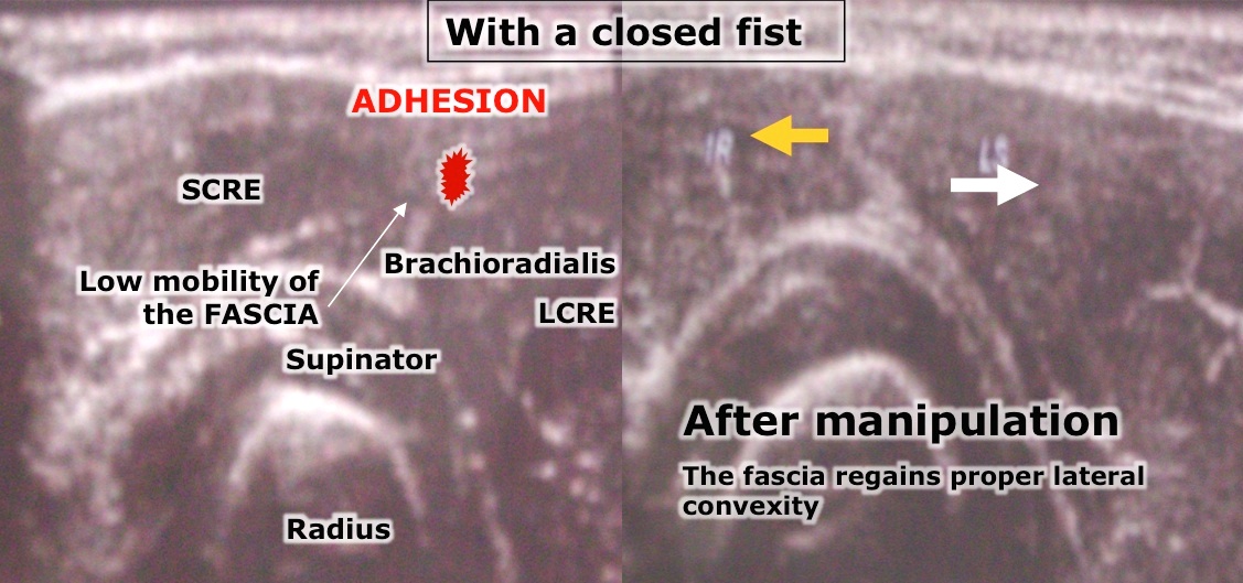 elbow-echography-osteopathy-3