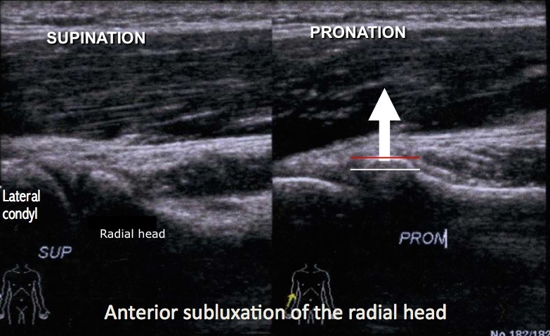 elbow-ultrasonography-osteopathy-4