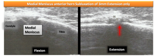 meniscus subluxation osteopathy