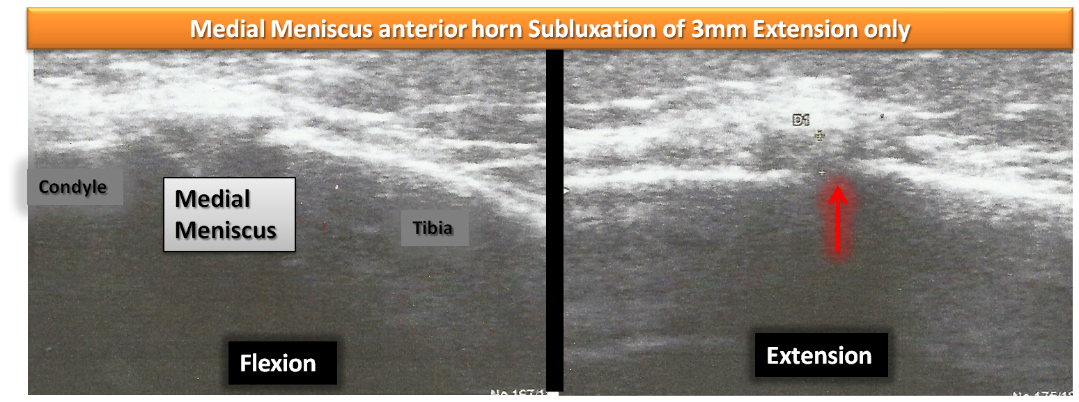 meniscus subluxation osteopathy