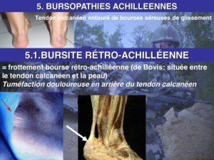 osteopathie bursite retroachilléenne