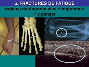 osteopathie fracture fatigue