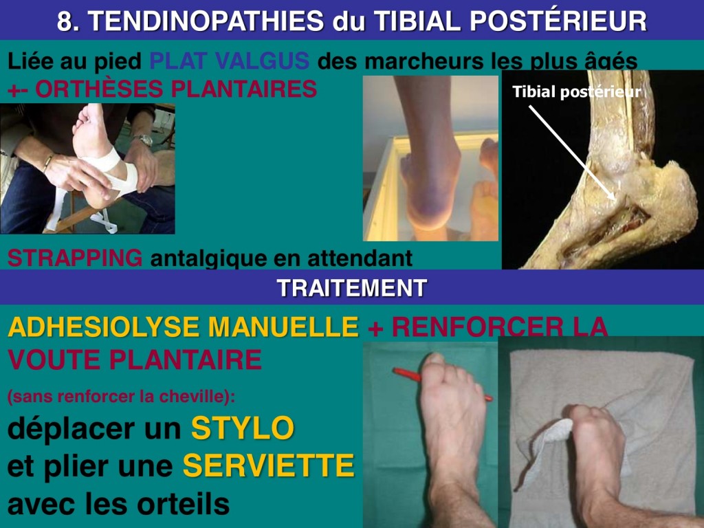 osteopathie tibial posterieur Adhésiolyse Manuelle Dynamique®