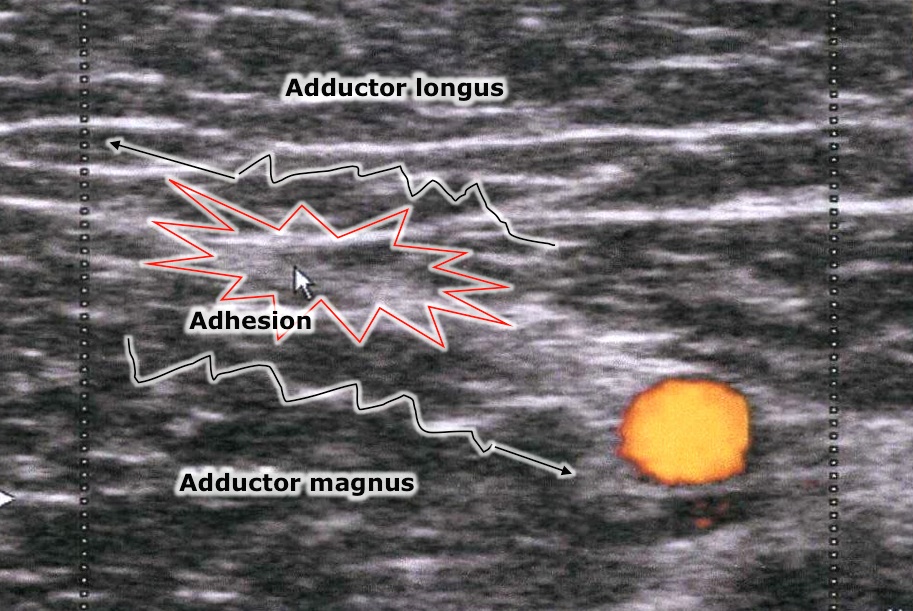 pubalgia-adherence-echography-3