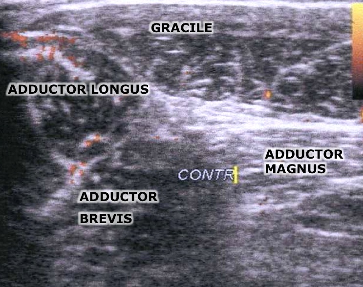 pubalgia-ebook-ultrasonography-2