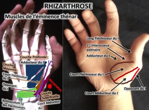 rhizarthrose ostéopathe
