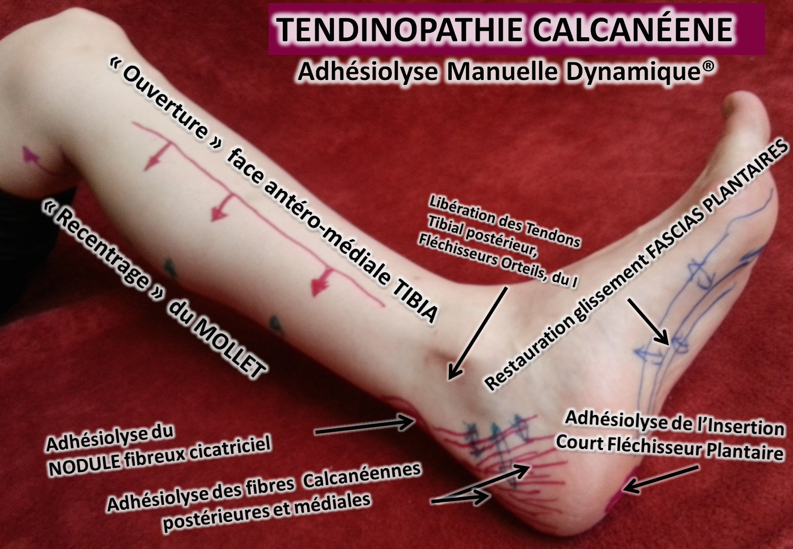 tendinite-achille-osteopathie.png