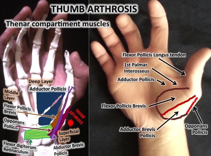 thumb-arthrosis-by-adhesions-osteopathic-treatment