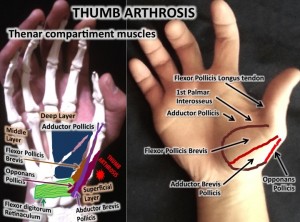 thumb arthrosis osteopathy